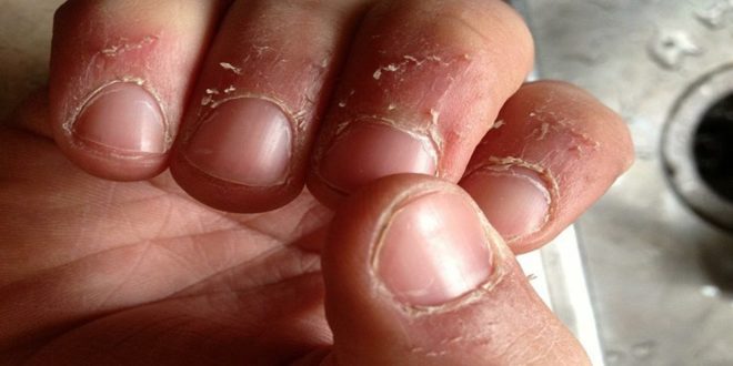 Peeling of skin around nails
